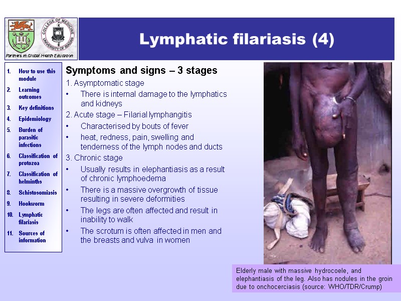 Lymphatic filariasis (4) Symptoms and signs – 3 stages 1. Asymptomatic stage There is